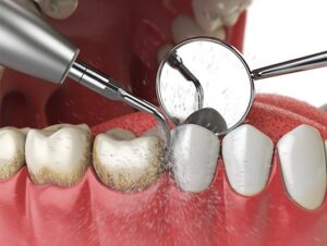 Photo of Dental Cleaning - Scaling and Polishing
