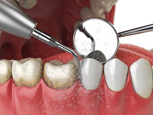 Early Signs of Dental Disease