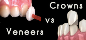 image describes the difference between a crown or veneer  