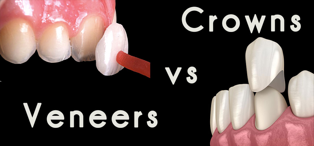 image describes the difference between a crown and veneer