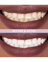 Before and After whitening article