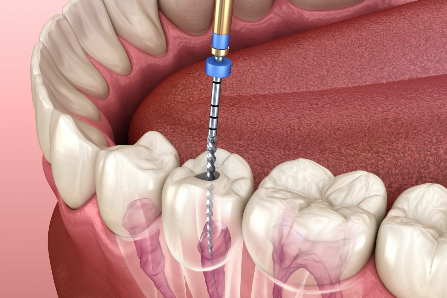 This article explains why a root canal be done on a tooth