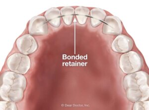 Importance of retainers