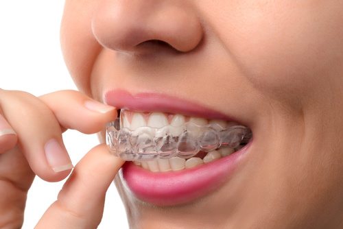 Article on why retainers are required after braces