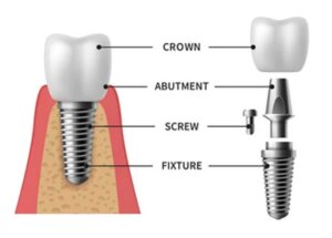 Cost of dental implant article in Kenya